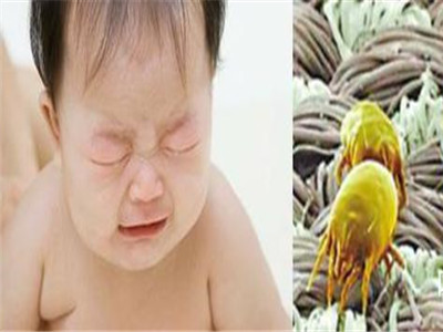 螨虫过敏症状 身体出现这些就需要小心了