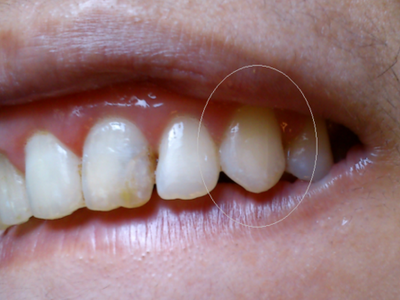 我们牙齿的外层是牙釉质以及牙本质,是非常坚硬的,因为牙釉质没有