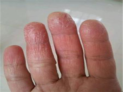 手指脱皮是怎么回事 3种情况告诉你原因