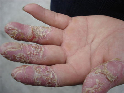 手藓最主要的原因是真菌的感染,只要涂点治疗手藓的软膏,让手上的老皮