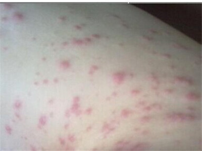 夏季常见的皮肤过敏症状 蚊虫叮咬引发过敏