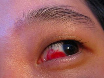 这样治疗很有效果    红眼病有个专业的医学称呼--急性结膜炎