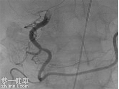 毛细血管堵塞怎么办 三大方法帮你快速缓解