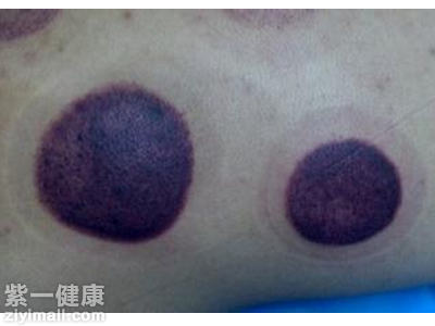 掌握拔罐后皮肤颜色鉴别要点 便于对症处理