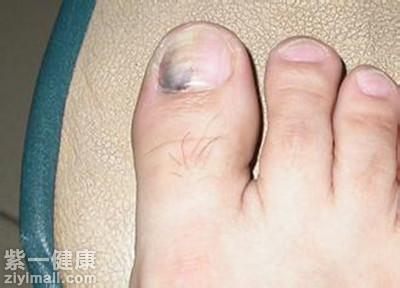 甲母痣很容易发展为甲色素瘤,这种瘤的存在就导致出现脚趾甲发黑的