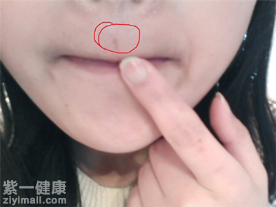 人中长痘的原因 哪些因素会导致人中痘