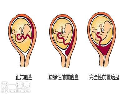 胎盘低置能顺产吗了解实际情况快速解决