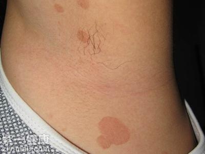 汗斑早期症状是怎样的 【盘点】汗斑早期三种症状表现