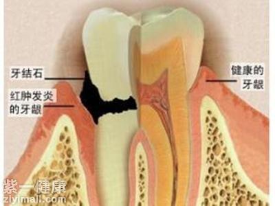 牙结石怎样去除 专家解读牙结石风险及医治方式