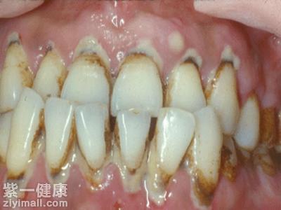 牙龈炎和牙周炎的区别 四个要素区分牙龈炎和牙周炎