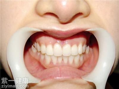 牙槽骨突出是什么原因 四大因素造成这种现象