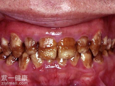 氟斑牙的危害大部分是表面症状,但是不排除是氟中毒的前期征兆.