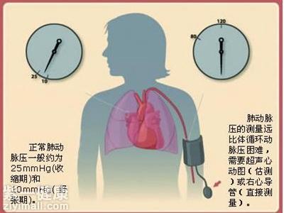肺动脉高压的原因揭露肺动脉高压的发生骗局