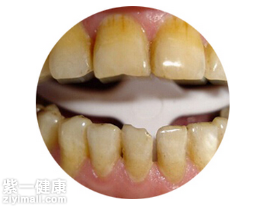 什么是四环素牙 了解四环素牙的症状及分类