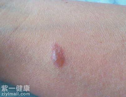 被烟头烫伤怎么办 做好下面三个步骤