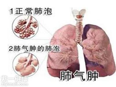 肺大泡能自愈吗 类型不同治愈能力不一致