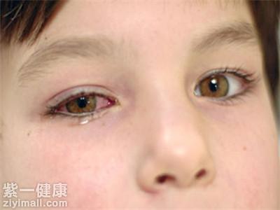 眼睛角膜炎怎么治疗 分享治疗眼睛角膜炎的方法