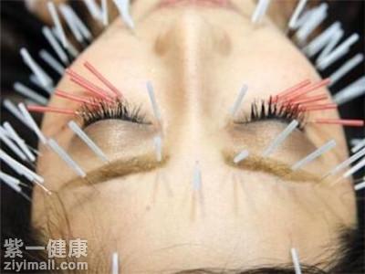 针灸美容是否有效 专家分析情况不同治疗方法不同