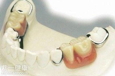 老人掉牙是该种牙好还是装假牙好 比比才知道