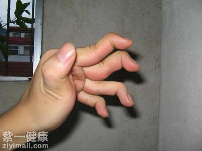 手指关节变形怎么治 为你介绍其两种治疗方法