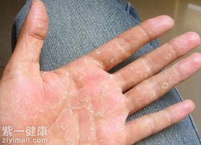 手癣是一种比较常见的真菌感染疾病,这种疾病会让人手大量脱皮,会
