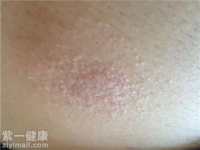 胰岛素过敏是什么 解析胰岛素过敏的治疗方法