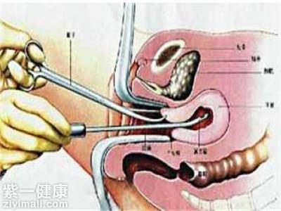 清宫手术即刮宫,用于清除人流术后流产不全停留于宫腔内的组织