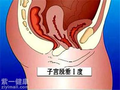 产后子宫下垂怎么治疗 产后子宫下垂运动疗法