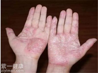 手癣有哪些危害 如何预防手癣