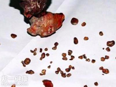 的很多部位都会发生结石,如眼结膜结石,鼻石,牙石,喉部结石