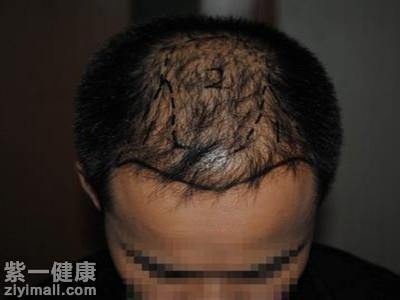 植发可靠吗 保证毛囊存活率是关键_紫一商城