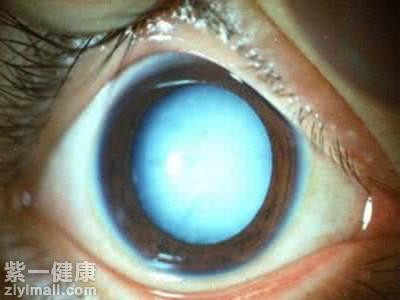 青光眼是怎样形成的 白内障过熟会诱发青光眼出现