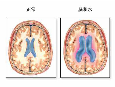 脑水肿图片分析图片