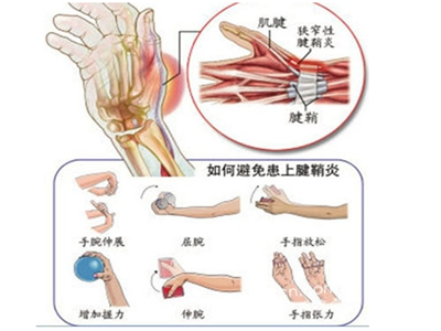 手腕腱鞘炎危害是什么 手腕腱鞘炎如何治疗