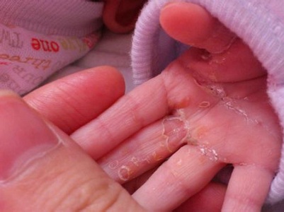 婴儿手指脱皮是怎么回事