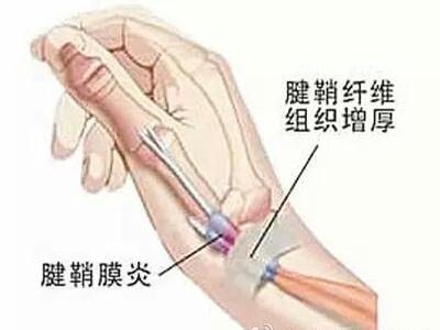 手腕腱鞘炎偏方有哪些 产妇治疗腱鞘炎不吃药的方法