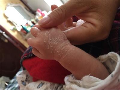 一,注意宝宝皮肤的清洁和保湿