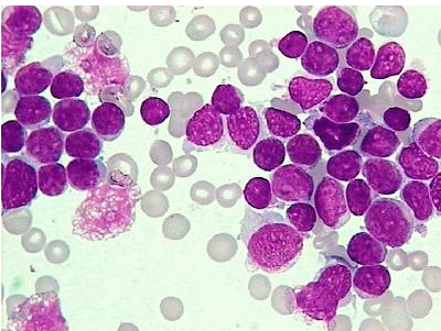 真正的白血病人,血常规的确是会有变化,主要是白细胞与血小板两个指标