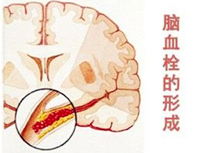 脑血栓会隔代遗传吗揭秘易导致脑血栓形成的四大病因