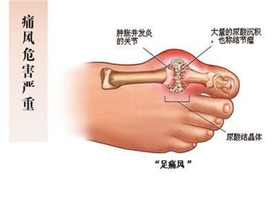 大家也了解了脚底板疼痛可能引起的疾病,对于脚底板疼痛是痛风的说法