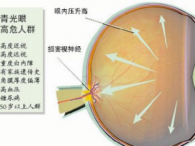 什麼是青光眼 全面瞭解青光眼及其類型