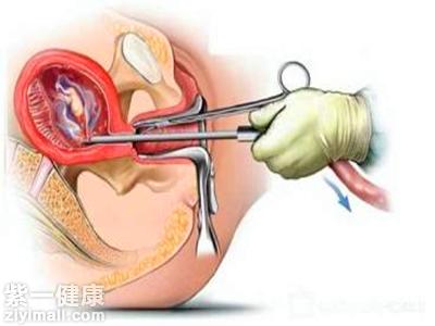 什么是无痛人流为你揭秘无痛人流的好处以及危害