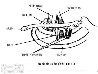 胸廓出口綜合徵的調理方法兩種方法幫你擺脫病症