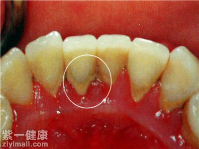 原因引起的若有牙石后不及时 去除就会越积越多渐渐造成很多牙龈方面