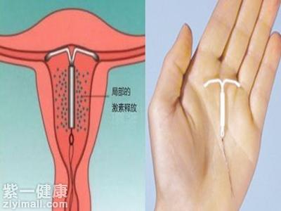 宫颈糜烂可以取环吗视病情轻重程度而定