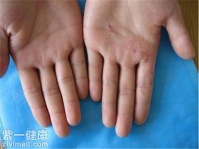 手足癣用什么药最好 盘点治疗手足癣的4种药物