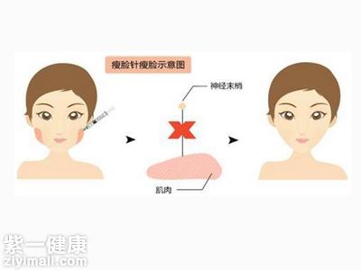 溶脂针适用于小面积局部肥胖者减肥用,比如想减掉双下巴,以及面部局部