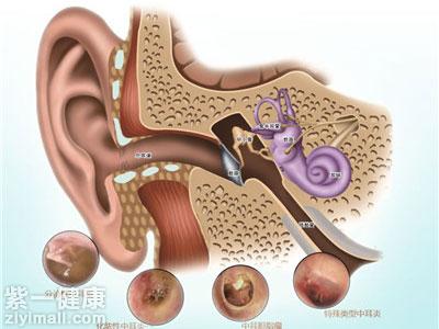 中耳炎治疗