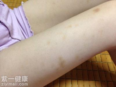 淤青上鸡皮肤(鸡身上有淤青是怎么回事)
