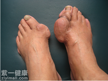 什么药物可消除痛风石